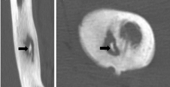 Sequestro Osseo na osteomielite